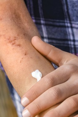 Bir çocuğun ellerinde atepik deri iltihabı.