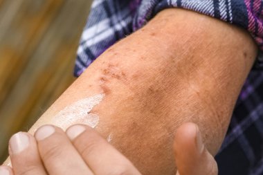 Bir çocuğun ellerinde atepik deri iltihabı.