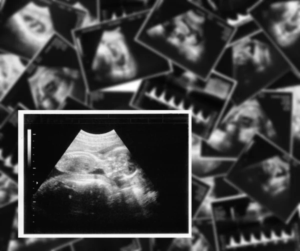 Imagen Ultrasonido Bebé —  Fotos de Stock