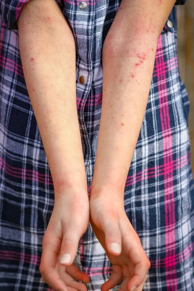 Wounds Atepic Dermatitis Hands Child — Stock Photo, Image