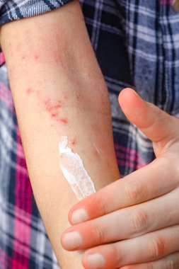 Bir çocuğun ellerinde atepik deri iltihabı.