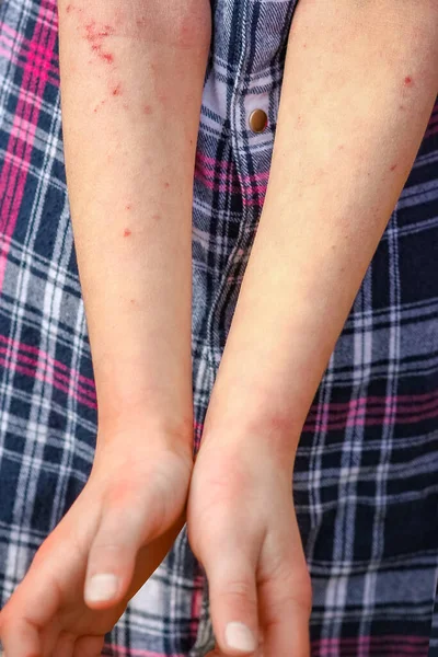 Wounds Atepic Dermatitis Hands Child — Stock Photo, Image