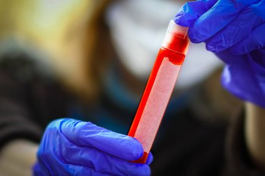 Coronavirus kan testi 2019-2020 arası bir kızda yapılmış. Crown virüs salgını. Salgın viral solunum sendromu. Çin