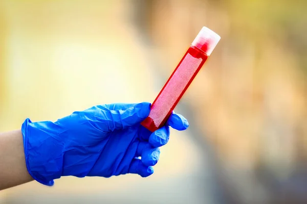 Nas Mãos Tubo Teste Com Sangue Para Análise Vírus Covid — Fotografia de Stock