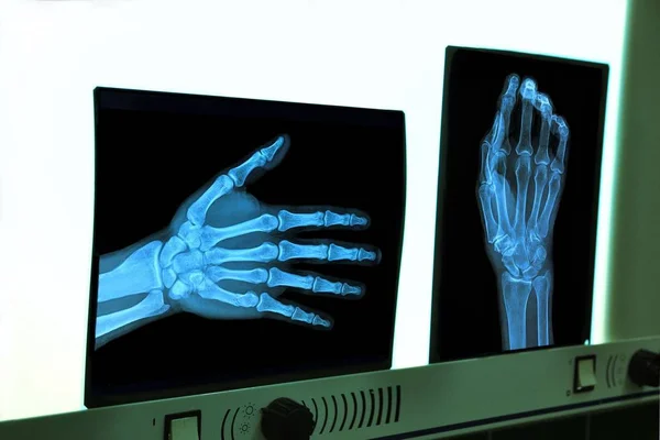 Negatoscope met xray van hand — Stockfoto