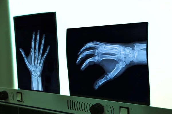 Negatoscope with xray of hand — Stock Photo, Image