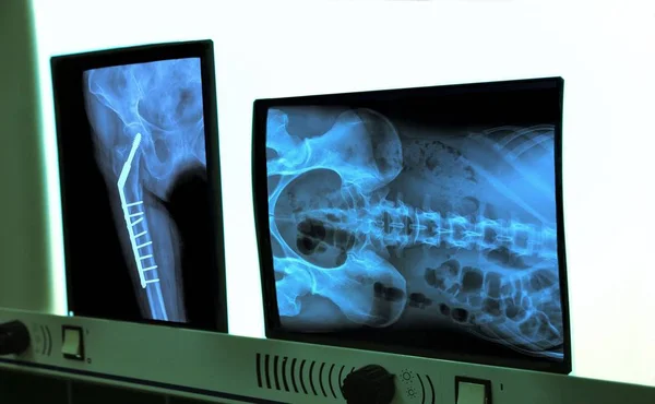 Negatoscope with xray of hip and spine — Stock Photo, Image