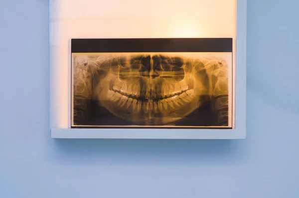 Analizując Dental Rentgenowskie Zęba Rtg Podglądzie Ścianie — Zdjęcie stockowe