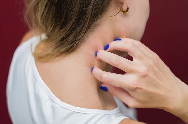 Fantastisk Koncept Allergi Hudsygdomme Ung Kvinde Ridser Sig Selv - Stock-foto