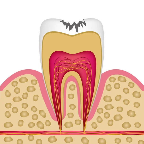 Structure des dents en coupe transversale avec caries à utiliser sur les affiches , — Image vectorielle