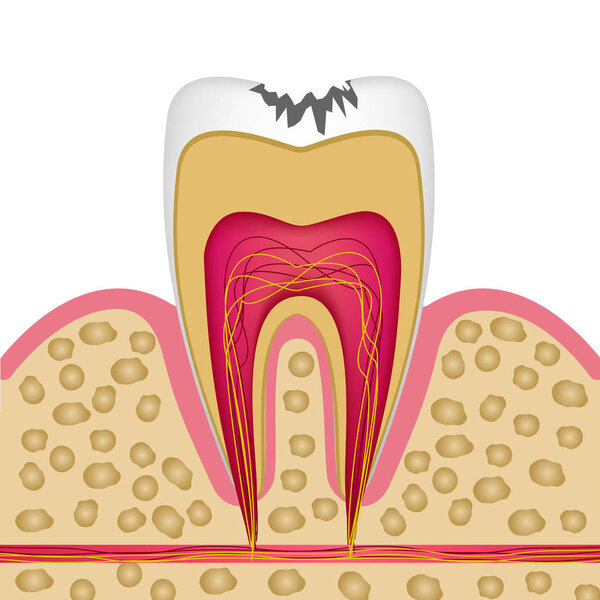 Tooth structure in cross section with caries to use on posters, 