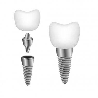 Diş implantı promosyon kitapçıklar için vektör çizim, 
