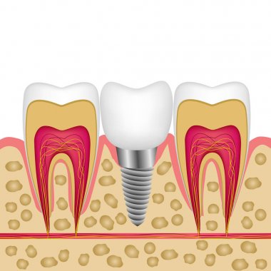 Vektör çizimi bir diş implantı kemik dişlerinin arasında fo