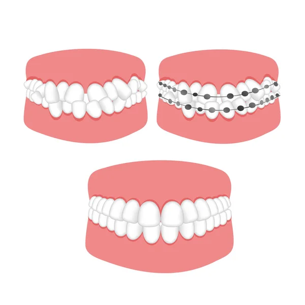 Ortodontická léčba malocclusion rovnátka zubů. — Stockový vektor