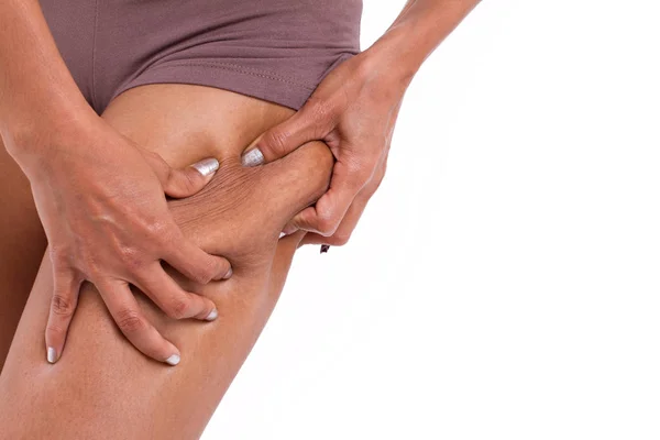 Frauenhand mit übermäßigem Beinfett oder Cellulite — Stockfoto