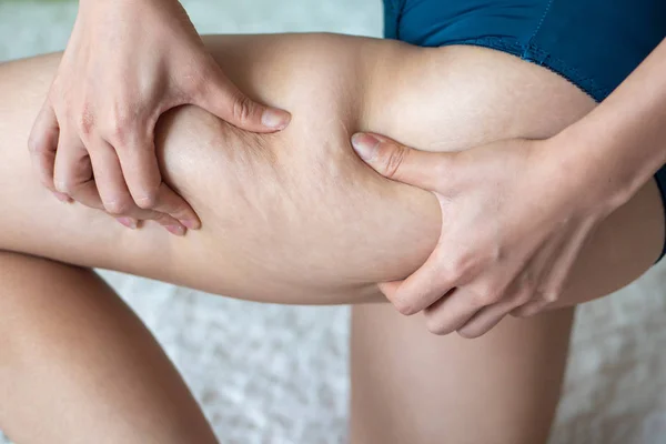 Fet Kvinna Fet Flicka Fett Ben Med Celluliter Hand Kvinna — Stockfoto