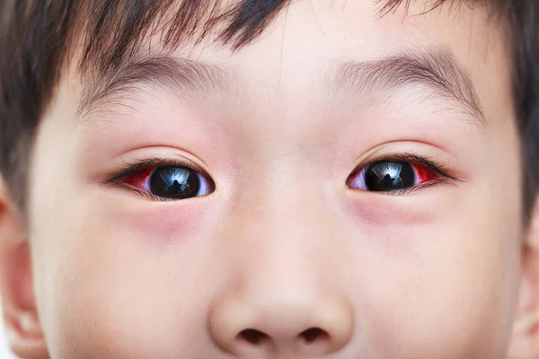 Close-up van chronische conjunctivitis met een rode iris. — Stockfoto