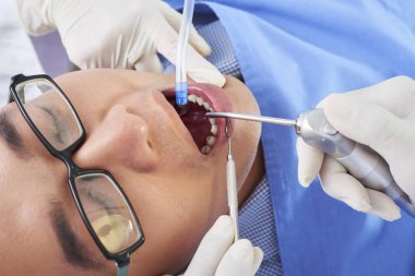 Yukarıdan, Asyalı adamın diş hekimlerinde diş ameliyatı olurken yakın plan çekimleri.