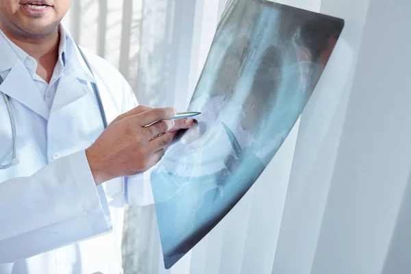 Imagen Recortada Del Médico Examinando Los Pulmones Radiografía Del Paciente —  Fotos de Stock