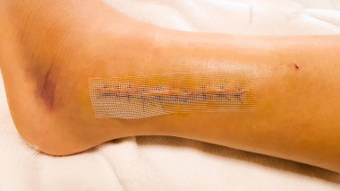 Ameliyattan sonra bacağında yeni dikişler var. Zımbalı ayak bileği ameliyatı izi. Ameliyat yarasıyla ayak bileği kırılmış.