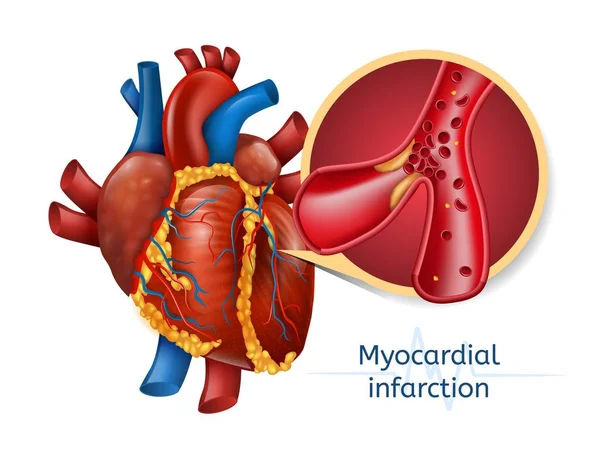 Miyokard İnfarktüsü. 3D Realostic kalp — Stok Vektör