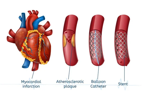 Miokardiális infarktus. 3D Realostic Stent szívében — Stock Vector