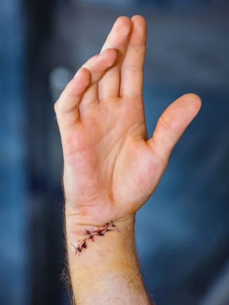 Cicatriz Fresca Muñeca Después Cirugía Tendones Nervios — Foto de Stock