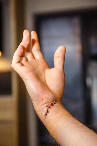 Cicatriz Fresca Pulso Após Cirurgia Tendão Nervo — Fotografia de Stock