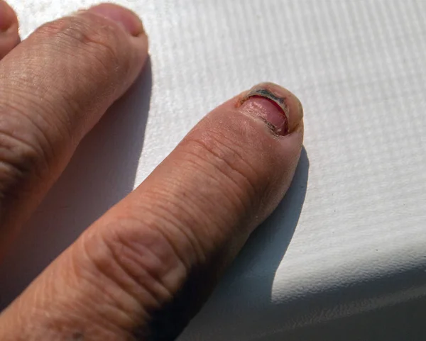 Damaged finger nail. Formation of the new instead of the old — Stockfoto