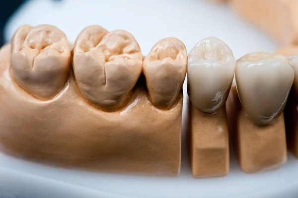 Dental prosthesis model for teeth. Dental prosthesis model with ceramic teeth isolated on the black background.
