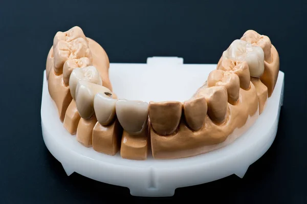Keramische Zahnimplantate Vorderseite Eines Zahnersatzmodells Auf Weißem Spezifischen Träger Isoliert — Stockfoto
