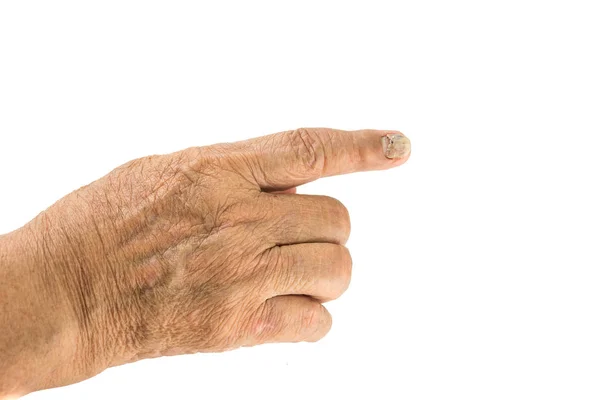 Ouderen Fungal nagel infectie aan kant — Stockfoto
