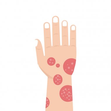 Hand with psoriasis or Eczema clipart