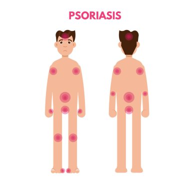 Areas of body Psoriasis clipart