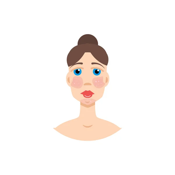 A psoriasis, az Sle jelenség nő — Stock Vector