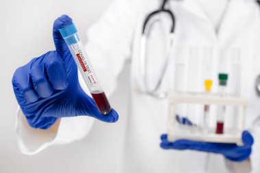 Bilim adamı doktor, koronavirüs için pozitif kan testi tüpü örneği tutuyor. Coronavirüs salgını ve salgın konsepti.