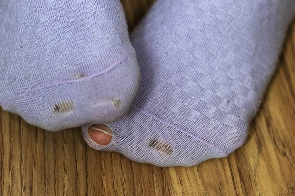Feet in worn out socks close up. Worn socks with a hole and a finger sticking out of them.