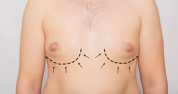 Męskie ciało, męskie piersi, ginekomastia. Korekta piersi u mężczyzn, Chirurgia plastyczna, Tło, medyczne — Zdjęcie stockowe