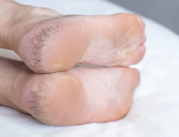 Сухая потрескавшаяся кожа на каблуках ног, крупным планом. Концепция серьезных кожных заболеваний и почечной недостаточности — стоковое фото
