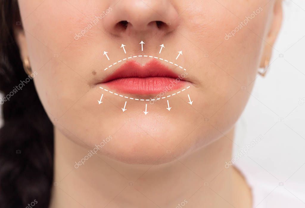 Girls face with painted lips and white markers on the lips. The concept of lip augmentation using contouring and cannulas, cosmetology
