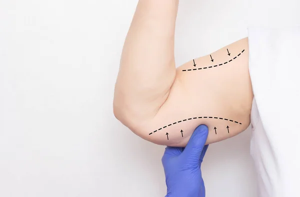 Doctor holds the hand of a female patient on a white background. The concept of skin tightening on the hand and fat removal, plastic surgery, markers, copy space, brachioplasty — Stock Photo, Image