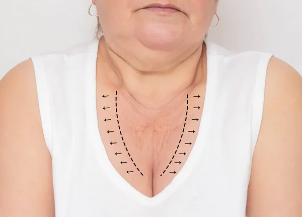 Kobieta z problemem skóry w obszarze dekoltu na białym tle. Koncepcja chirurgii plastycznej w medycynie, zaciśnięcie skóry na szyi i dekolt, markery — Zdjęcie stockowe