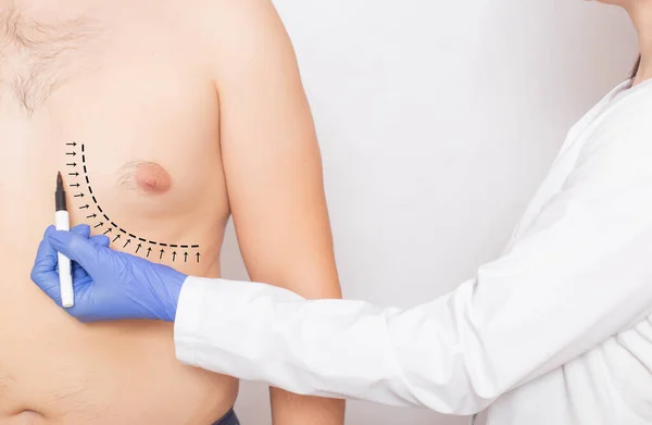 医生，整形外科医生，用一个标记标记外科手术的标记，以减少男性乳房上的脂肪。 Gnecomastia现代程序概念 — 图库照片