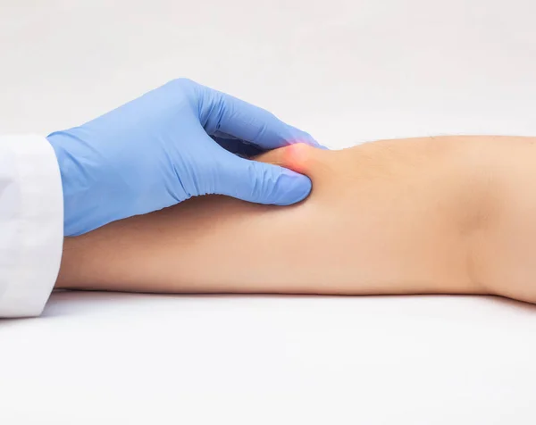El dermatólogo médico examina la herida subcutánea en el brazo de los pacientes, de cerca. El concepto de enfermedades de la piel, lipoma —  Fotos de Stock