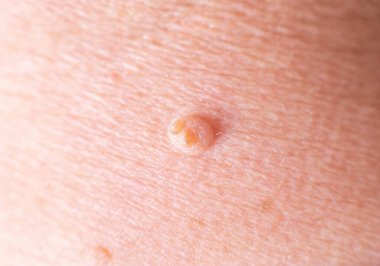 Bir insanın derisinde büyük bir siğil, arka plan, makro, dermatoloji