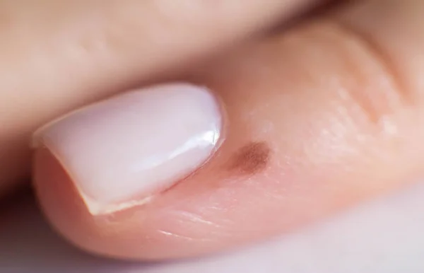 Small mole on a finger near a person s nail, close-up — 스톡 사진