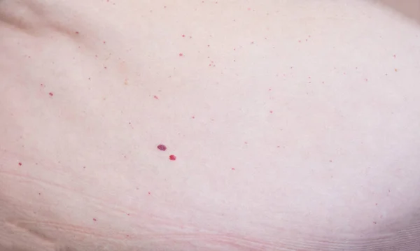 Moles vermelhos de nevos no abdômen em humanos, hemangioma — Fotografia de Stock