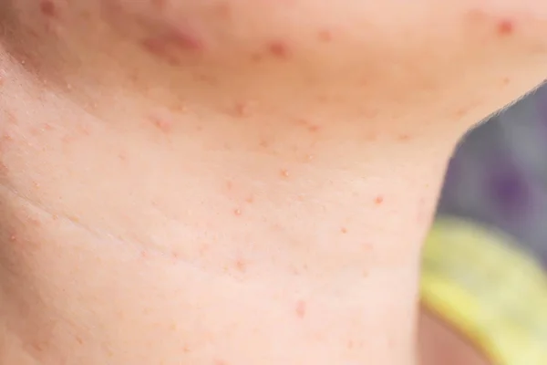 Acne vermelha e uma erupção cutânea no rosto e pescoço de uma menina, macro, hormônio — Fotografia de Stock