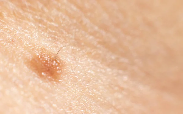 Maulwurf auf der Haut einer Person, Dermatologie, Hintergrund, Kopierraum. Makro — Stockfoto