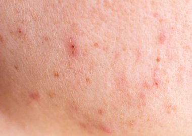 Kızın yüzünde kırmızı sivilce, arka plan, makro